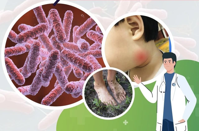 CHỦ ĐỘNG PHÒNG CHỐNG BỆNH WHITMORE TRÊN ĐỊA BÀN PHƯỜNG EA KAO
